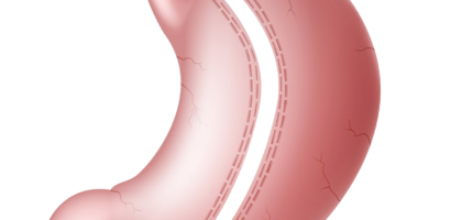 gastric sleeve