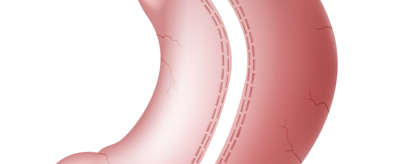 gastric sleeve