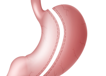 gastric sleeve