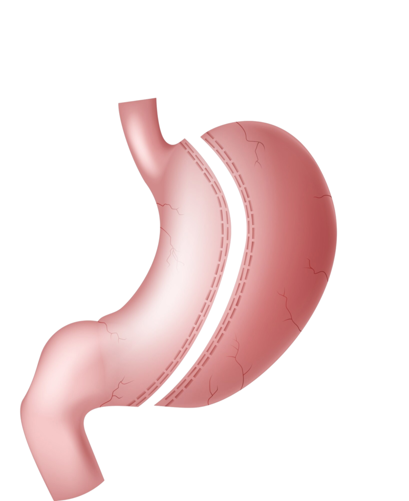 Leading the Way in Weight Loss Solutions: Al Taie Center Sets the Standard for Gastric Sleeve Surgery in Dubai & Abu Dhabi